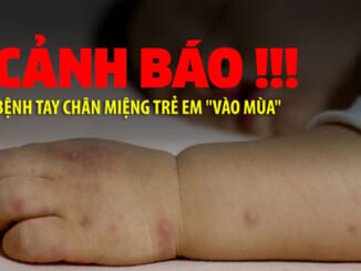 'Điểm mặt' 7 căn bệnh mùa hè nguy hiểm trẻ thường hay mắc phải