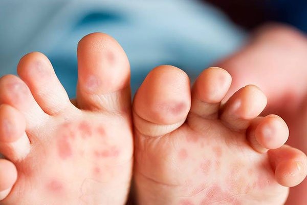 Bệnh tay chân miệng do loại virus thuộc nhóm Enterovirus gây ra. Ảnh minh họa 