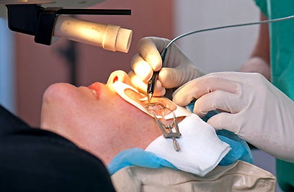 Trước khi phẫu thuật lasik, bệnh nhân cần được tư vấn đầy đủ về những vấn đề có thể gặp phải sau phẫu thuật.