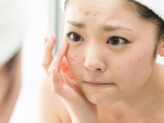 Tiêu diệt thâm mụn với những công thức mặt nạ thiên nhiên