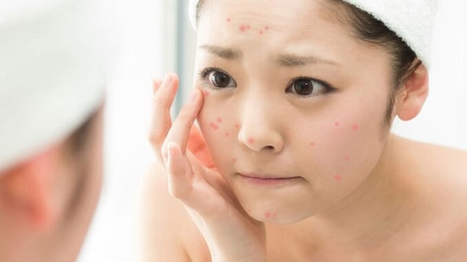 Tiêu diệt thâm mụn với những công thức mặt nạ thiên nhiên Tiêu diệt thâm mụn với những công thức mặt nạ thiên nhiên
