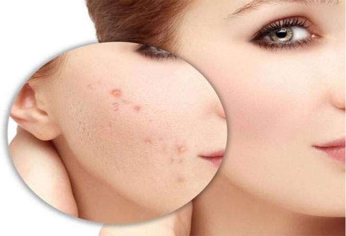 Xử lý mụn không đúng cách để lại thâm