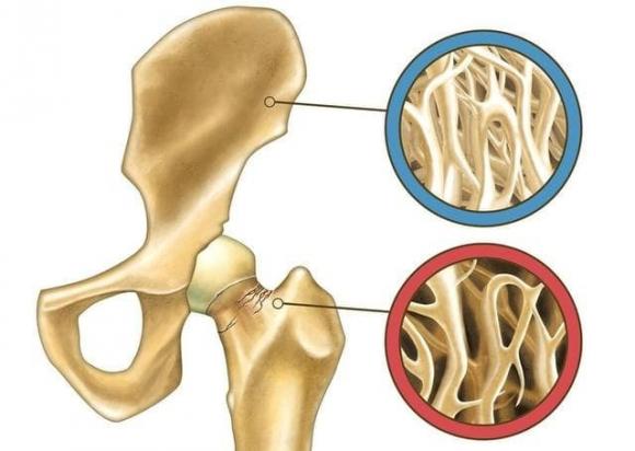 chăm sóc sức khỏe đúng cách, lưu ý khi chăm sóc sức khỏe, thực phẩm gây hại cho xương