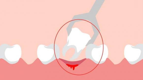 chết não sau khi nhổ răng, nhổ răng, lưu ý khi nhổ răng