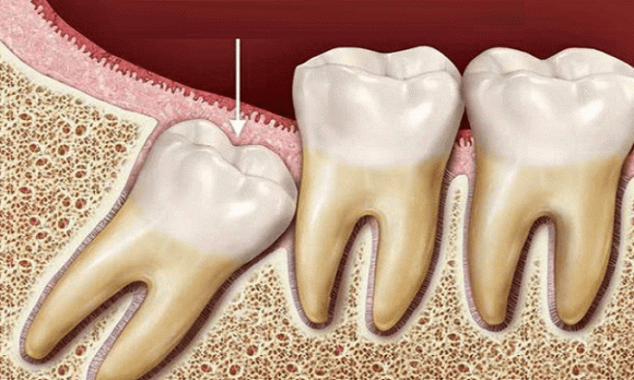 chết não sau khi nhổ răng, nhổ răng, lưu ý khi nhổ răng