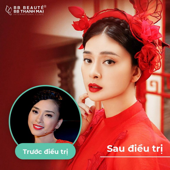 BB Thanh Mai, Ngô Thanh Vân, Trẻ hóa da công nghệ cao