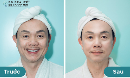 BB Thanh Mai, Trẻ hóa da, Ultherapy