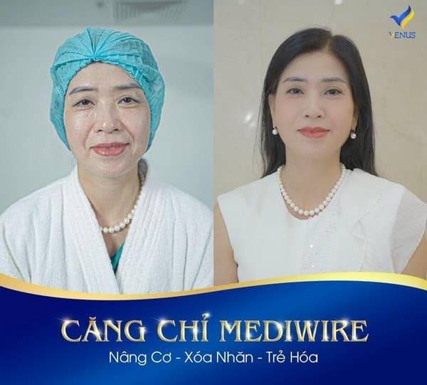 Thẩm Mỹ Viện Quốc Tế Venus, Căng da Mediwire, Trẻ hóa da