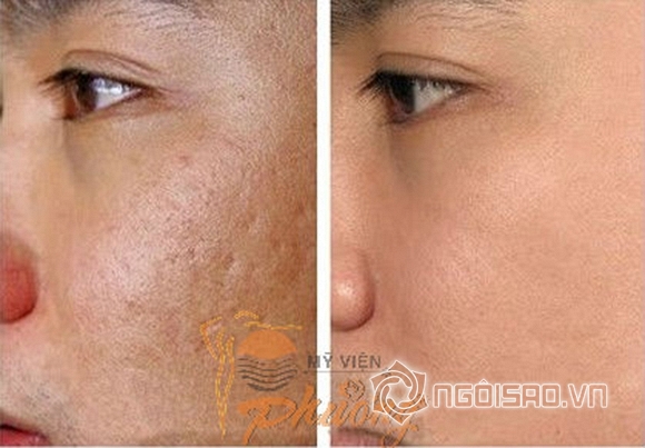 Thẩm mỹ Phương, công nghệ PRP, PRP, Platelet Rich Plasma, Huyết tương giàu tiểu cầu, Mỹ viện Phương