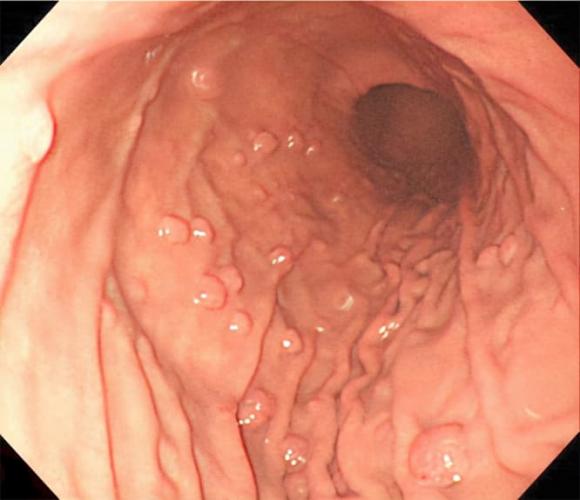 Polyp dạ dày có nguy cơ ung thư, 8 loại người này dễ ‘trúng tuyển’ nhất