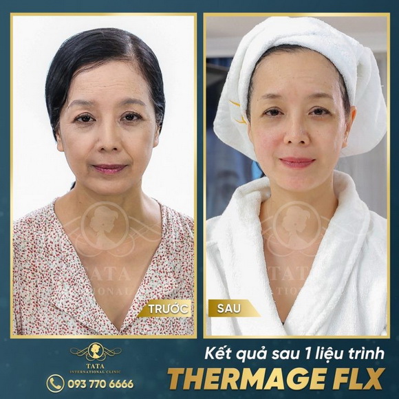 Trẻ hóa da, Làm đẹp không dao kéo, TaTa International Clinic