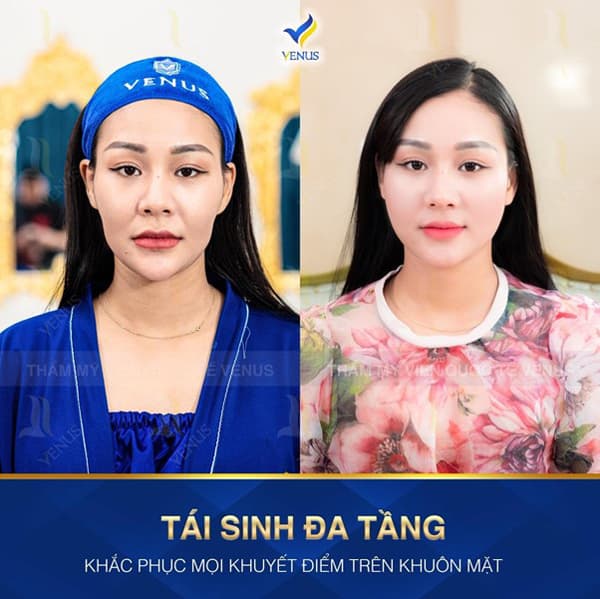 thẩm mỹ Venus, tái sinh đa tầng, trẻ hóa da