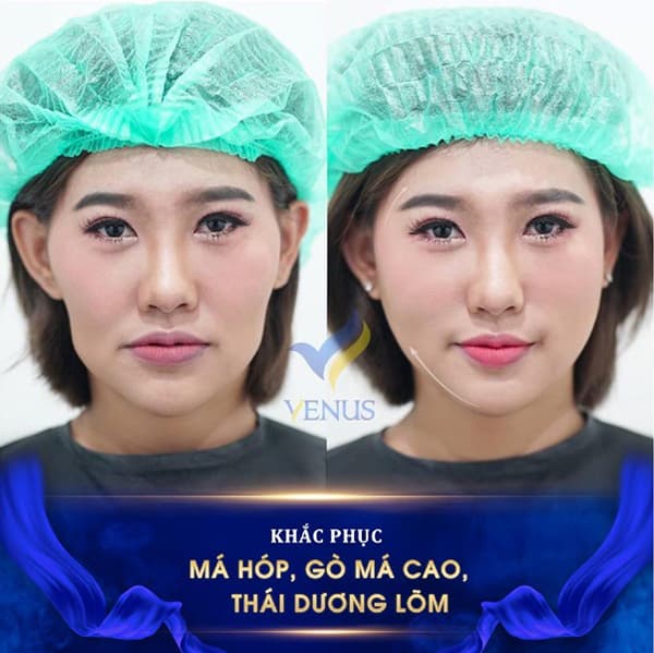 thẩm mỹ Venus, tái sinh đa tầng, trẻ hóa da