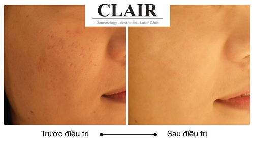 Clair Clinic, Trẻ hóa da, Nâng cơ mặt