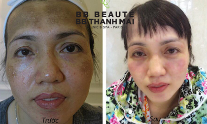 Lão hóa da, BB Beauté – BB Thanh Mai, Trẻ hóa da