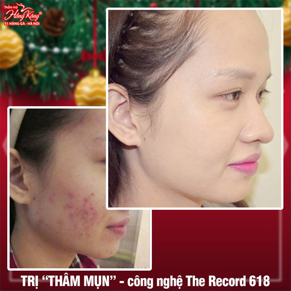 Trị thâm mụn, Thẩm mỹ Hồng Kông, trị mụn công nghệ cao