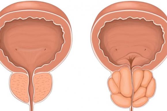 Tuyến tiền liệt, viêm tuyến tiền liệt, sức khỏe nam giới