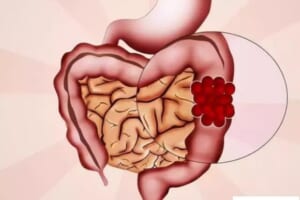 Polyp đại trực tràng phần lớn là do những nguyên nhân này, đừng làm những hành vi ‘gây họa’ nữa