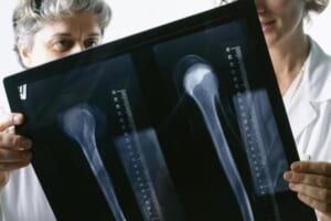 Người mẫu Châu Kim Sang bị ung thư xương! 2 người này cần chú ý: nếu có 3 điểm dị thường trên cơ thể, tốt nhất nên kiểm tra sớm